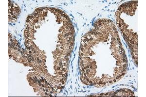 Immunohistochemical staining of paraffin-embedded Adenocarcinoma of Human colon tissue using anti-ACAT2 mouse monoclonal antibody. (ACAT2 antibody)