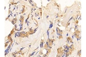 Detection of CK10 in Human Breast cancer Tissue using Polyclonal Antibody to Cytokeratin 10 (CK10) (Keratin 10 antibody  (AA 153-456))