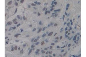 Detection of NCL in Human Mastadenoma Tissue using Polyclonal Antibody to Nucleolin (NCL) (Nucleolin antibody  (AA 388-569))