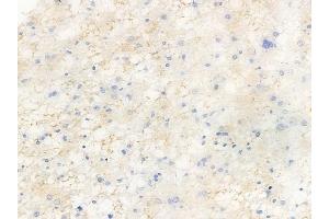 ABIN6256627 and ABIN6267491 at 1/100 staining human astrocytoma by IHC-P. (VEGFR2/CD309 antibody  (pTyr1214))