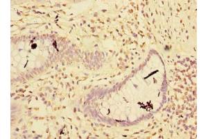 Immunohistochemistry of paraffin-embedded human colon cancer using ABIN7151160 at dilution of 1:100 (RNF181 antibody  (AA 2-153))