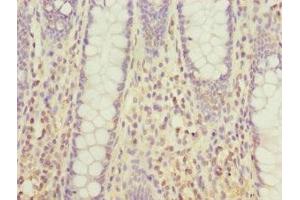 Immunohistochemistry of paraffin-embedded human colon cancer using ABIN7172381 at dilution of 1:100 (DHDH antibody  (AA 1-334))