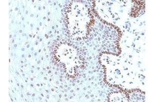 Formalin-fixed, paraffin-embedded human cervical carcinoma stained with c-Myc antibody (9E10. (c-MYC antibody)