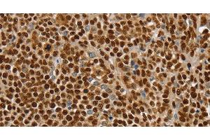 Immunohistochemistry of paraffin-embedded Human ovarian cancer using SSB Polyclonal Antibody at dilution of 1:30 (SSB antibody)