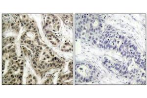 Immunohistochemical analysis of paraffin- embedded human breast carcinoma tissue using NF-kappa,B p105/p50 (phospho-Ser337) antibody. (NFKB1 antibody  (pSer337))