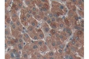 Detection of NPNT in Human Liver cancer Tissue using Polyclonal Antibody to Nephronectin (NPNT) (Nephronectin antibody  (AA 418-565))