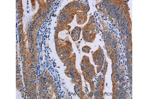 Immunohistochemistry of Human prostate cancer using ACP6 Polyclonal Antibody at dilution of 1:50 (ACP6 antibody)