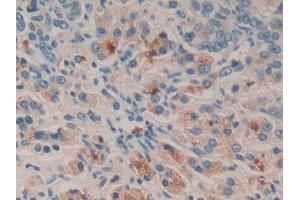 DAB staining on IHC-P; Samples: Human Prostate cancer Tissue (SGK2 antibody  (AA 40-311))