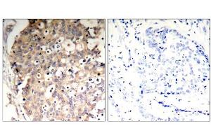 Immunohistochemical analysis of paraffin-embedded human breast carcinoma tissue, using SHP-1 (Phospho-Tyr536) Antibody (E011318). (SHP1 antibody  (pTyr536))