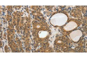 Immunohistochemistry of paraffin-embedded Human thyroid cancer tissue using RARA Polyclonal Antibody at dilution 1:40 (Retinoic Acid Receptor alpha antibody)