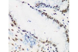 Immunohistochemistry of paraffin-embedded Human stomach cancer using KLF4 Polyclonal Antibody at dilution of 1:200 (40x lens). (KLF4 antibody)