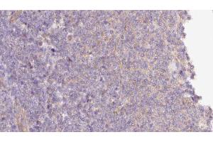 ABIN6273058 at 1/100 staining Human lymph cancer tissue by IHC-P. (MTO1 antibody  (N-Term))