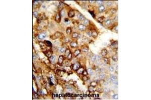 Formalin-fixed and paraffin-embedded human hepatocarcinoma reacted with DERL2 Antibody (C-term), which was peroxidase-conjugated to the secondary antibody, followed by DAB staining. (Der1-Like Domain Family, Member 2 (DERL2) (AA 191-218), (C-Term) antibody)