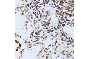 Immunohistochemistry of paraffin-embedded human lung cancer using TAPBP antibody. (TAPBP antibody)