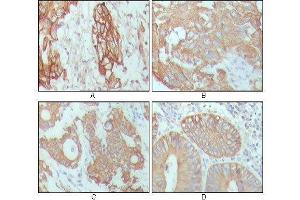 Immunohistochemical analysis of paraffin-embedded human breast carcinoma (A), hepatocarcinoma (B), stomach cancer (C) and colon cancer tissue (D), showing cytoplasmic location with DAB staining using CK18 mouse mAb. (Cytokeratin 18 antibody  (AA 391-483))