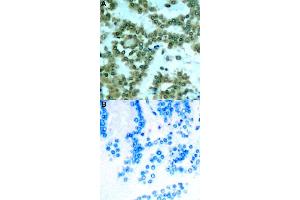 Immunohistochemical staining of human lung cancer tissue by PRKCQ (phospho S676) polyclonal antibody  without blocking peptide (A) or preincubated with blocking peptide (B) under 1:50-1:100 dilution.