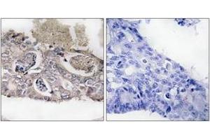 Immunohistochemistry analysis of paraffin-embedded human colon carcinoma tissue, using MARK2 (Ab-596) Antibody.