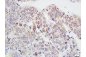 Formalin-fixed and paraffin embedded human hepatocellular carcinoma labeled with Anti-GAMT Polyclonal Antibody, Unconjugated  at 1:200 followed by conjugation to the secondary antibody and DAB staining. (GAMT antibody  (AA 101-200))