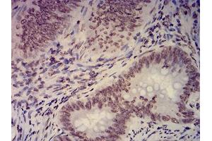 Immunohistochemical analysis of paraffin-embedded rectum cancer tissues using EHMT2 mouse mAb with DAB staining.