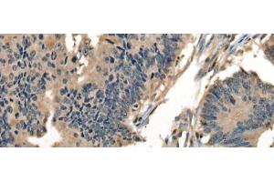 Immunohistochemistry of paraffin-embedded Human colorectal cancer tissue using DNAJC2 Polyclonal Antibody at dilution of 1:40(x200) (DNAJC2 antibody)