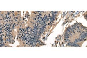 Immunohistochemistry of paraffin-embedded Human colorectal cancer tissue using DNAJC2 Polyclonal Antibody at dilution of 1:40(x200) (DNAJC2 antibody)