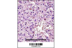 LDHA Antibody immunohistochemistry analysis in formalin fixed and paraffin embedded human hepatocarcinoma followed by peroxidase conjugation of the secondary antibody and DAB staining. (Lactate Dehydrogenase A antibody  (C-Term))