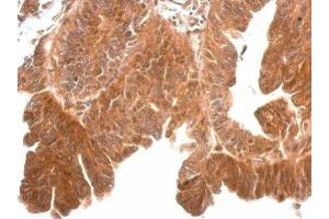 IHC-P Image KLK11 antibody [N1C3] detects KLK11 protein at cytosol on human gastric cancer by immunohistochemical analysis. (Kallikrein 11 antibody)