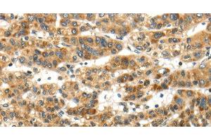 Immunohistochemistry of paraffin-embedded Human ovarian cancer tissue using PAPPA Polyclonal Antibody at dilution of 1:50 (PAPPA antibody)