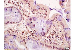Formalin-fixed and paraffin embedded human gastric cancer labeled with Anti-FZR1/CDC20C Polyclonal Antibody, Unconjugated (ABIN1714172) at 1:200 followed by conjugation to the secondary antibody and DAB staining (FZR1 antibody  (AA 141-240))