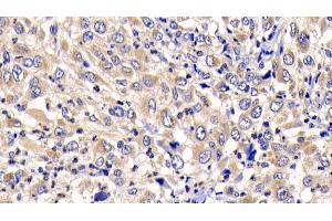 Detection of CTSK in Human Liver cancer Tissue using Polyclonal Antibody to Cathepsin K (CTSK) (Cathepsin K antibody  (AA 71-319))