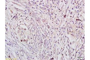 Formalin-fixed and paraffin embedded human gastric cancer labeled with Anti-phospho-DAXX (Ser495) Polyclonal Antibody, Unconjugated (ABIN757672) at 1:200 followed by conjugation to the secondary antibody