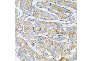 Immunohistochemistry of paraffin-embedded human esophageal cancer using Cytokeratin 1 (KRT1) (KRT1) Rabbit mAb (ABIN7268085) at dilution of 1:100 (40x lens). (Cytokeratin 1 antibody)