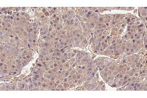ABIN6279265 at 1/100 staining Human liver cancer tissue by IHC-P.