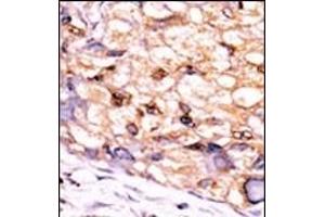 Formalin-fixed and paraffin-embedded human cancer tissue reacted with the primary antibody, which was peroxidase-conjugated to the secondary antibody, followed by DAB staining. (CTDSP1 antibody  (C-Term))