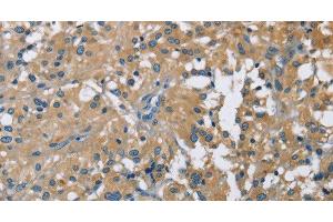 Immunohistochemistry of paraffin-embedded Human thyroid cancer using CAB39L Polyclonal Antibody at dilution of 1:40 (CAB39L antibody)