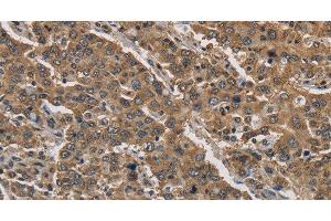 Immunohistochemistry of paraffin-embedded Human liver cancer tissue using JAG2 Polyclonal Antibody at dilution 1:30 (JAG2 antibody)