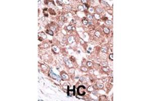 Formalin-fixed and paraffin-embedded human hepatocellular carcinoma tissue reacted with the BAK1 polyclonal antibody  , which was peroxidase-conjugated to the secondary antibody, followed by AEC staining. (BAK1 antibody  (N-Term))