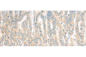 Immunohistochemistry of paraffin-embedded Human liver cancer tissue using CDKAL1 Polyclonal Antibody at dilution of 1:60(x200) (CDKAL1 antibody)