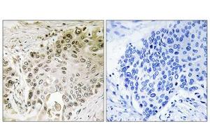 Immunohistochemistry analysis of paraffin-embedded human lung carcinoma tissue using RFX2 antibody. (RFX2 antibody  (C-Term))