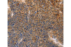 Immunohistochemistry of Human cervical cancer using MUSK Polyclonal Antibody at dilution of 1:30