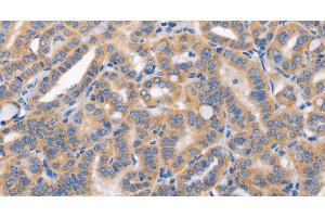Immunohistochemistry of paraffin-embedded Human thyroid cancer tissue using CARD17 Polyclonal Antibody at dilution 1:50 (CARD17 antibody)