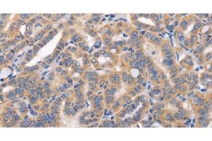 Immunohistochemistry of paraffin-embedded Human thyroid cancer tissue using CARD17 Polyclonal Antibody at dilution 1:50