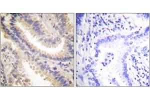 Immunohistochemistry analysis of paraffin-embedded human lung carcinoma tissue, using TIMP4 Antibody. (TIMP4 antibody  (AA 175-224))