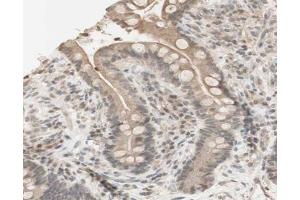 ABIN6267631 at 1/200 staining human colon cancer tissue sections by IHC-P. (PRKAA1 antibody  (pSer486))