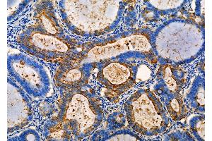 ABIN6257488 and ABIN6275420 at 1/100 staining Human ovarian cancer by IHC-P. (S100A5 antibody  (Internal Region))