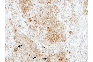 IHC-P Image Immunohistochemical analysis of paraffin-embedded human lung adenocarcinoma, using RAP1B, antibody at 1:100 dilution. (RAP1B antibody)