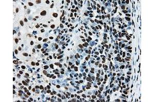 Immunohistochemical staining of paraffin-embedded Adenocarcinoma of breast tissue using anti-RPA2 mouse monoclonal antibody. (RPA2 antibody)