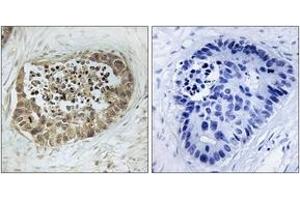 Immunohistochemistry analysis of paraffin-embedded human lung carcinoma, using SMC1 (Phospho-Ser966) Antibody. (SMC1A antibody  (pSer966))