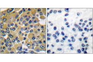 Immunohistochemistry analysis of paraffin-embedded human breast carcinoma tissue, using SHP-2 (Ab-542) Antibody. (PTPN11 antibody  (AA 508-557))
