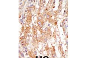 Formalin-fixed and paraffin-embedded human cancer tissue reacted with the primary antibody, which was peroxidase-conjugated to the secondary antibody, followed by DAB staining. (MAP3K6 antibody  (C-Term))
